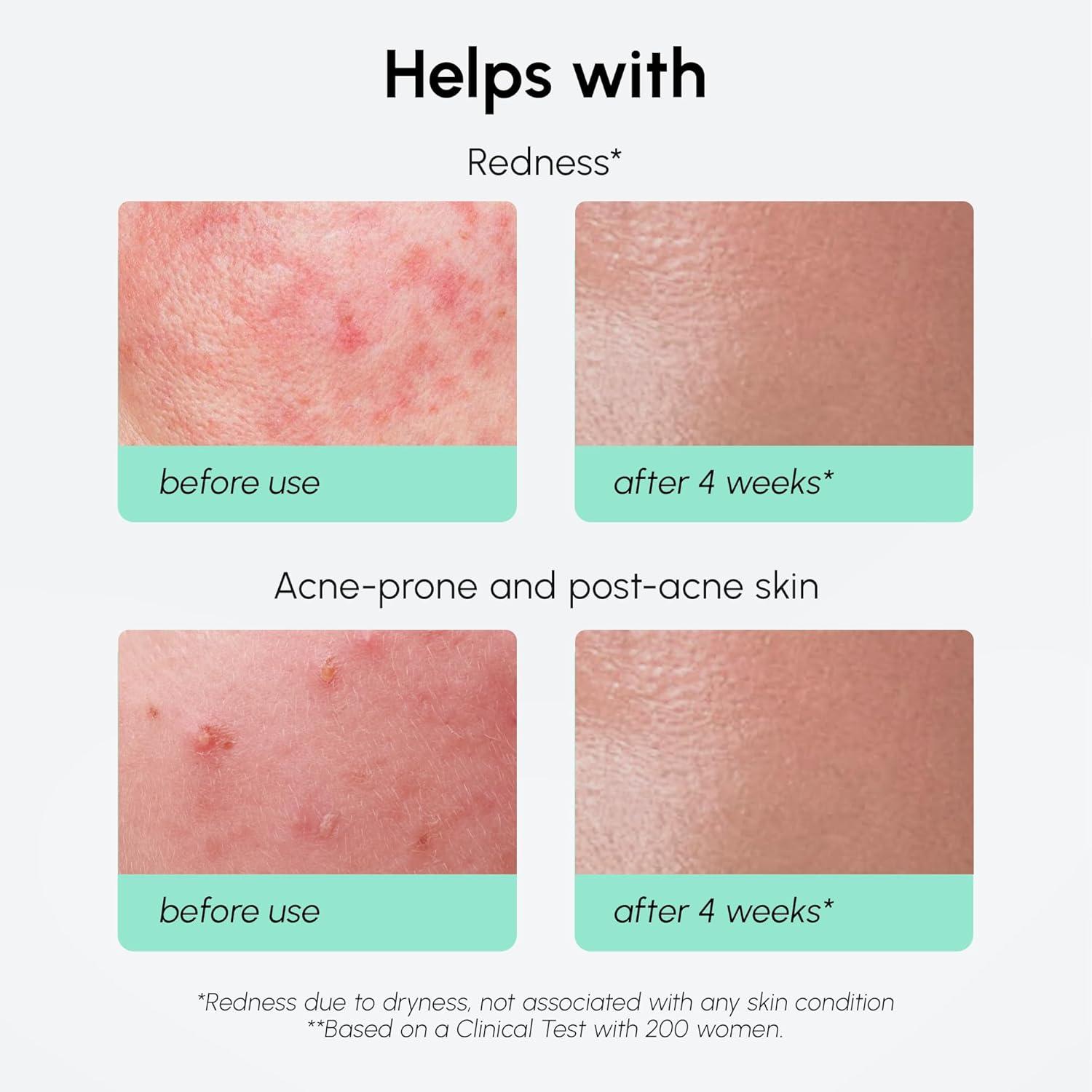 imageMAREE 10 Azelaic Acid Face Serum  Redness Soothing Hydrating Serum with Niacinamide Centella Asiatica ampamp Hyaluronic Acid  Relief Serums for Face ampamp Body  Azalecic Acid Skin Facial  Acido Azelaico